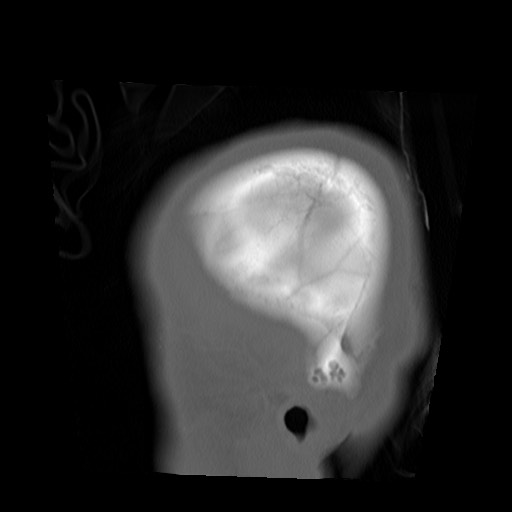 File:Chondrosarcoma - sphenoid wing (Radiopaedia 58259-67828 Sagittal bone window 2).jpg