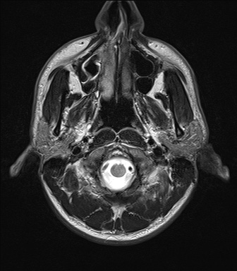 File:Chondrosarcoma - sphenoid wing (Radiopaedia 58259-67947 Axial T2 1).jpg