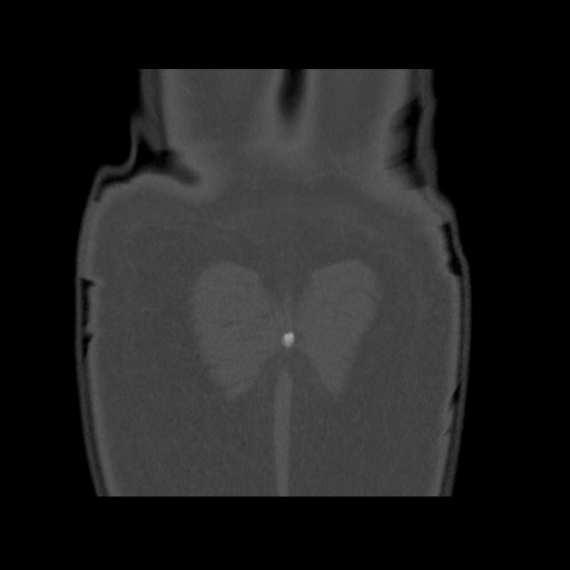 Chondrosarcoma of iliac wing (Radiopaedia 63861-72599 Coronal bone window 109).jpg