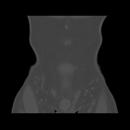 Chondrosarcoma of iliac wing (Radiopaedia 63861-72599 Coronal bone window 21).jpg