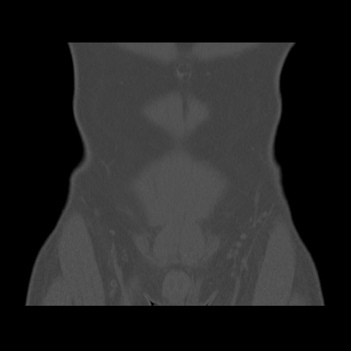 Chondrosarcoma of iliac wing (Radiopaedia 63861-72599 Coronal bone window 23).jpg