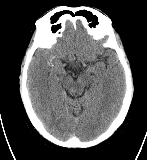 File:Chondrosarcoma of skull base- grade II (Radiopaedia 40948-43653 Axial non-contrast 12).png
