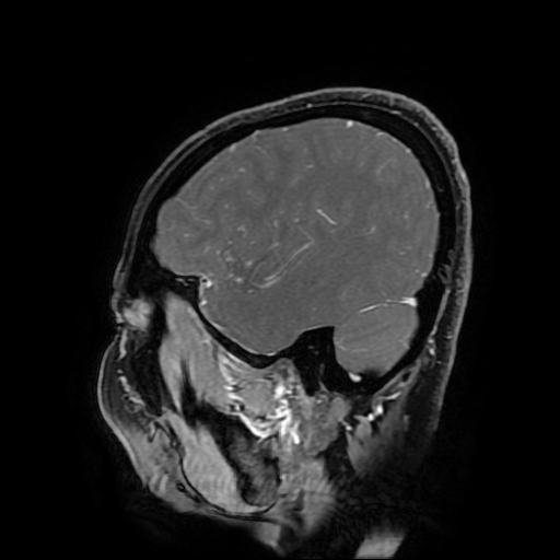 Chordoid glioma of third ventricle (Radiopaedia 91612-109340 F 161).jpg