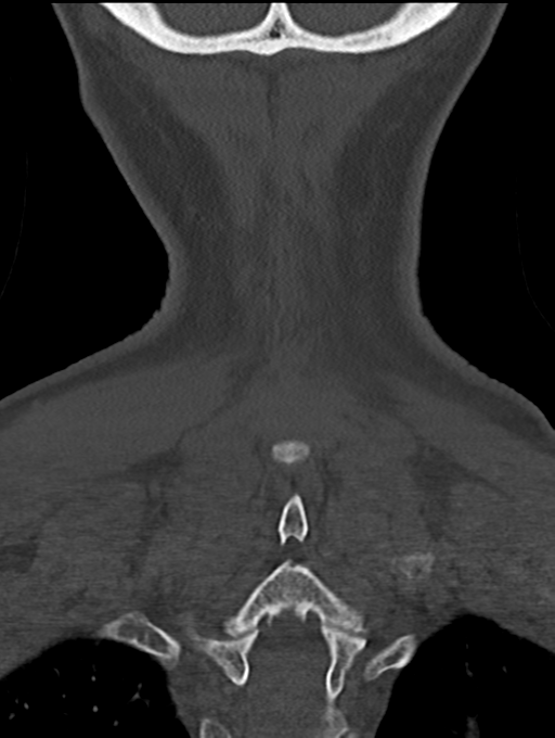 Chordoma (C4 vertebra) (Radiopaedia 47561-52188 Coronal bone window 56).png