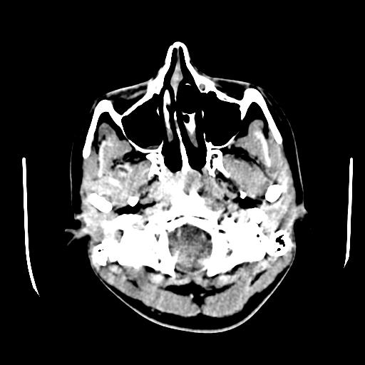 File:Choriocarcinoma of ovary with cerebral and pulmonary metastases (Radiopaedia 25983-26118 C+ arterial phase 3).jpg