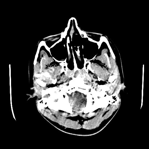 File:Choriocarcinoma of ovary with cerebral and pulmonary metastases (Radiopaedia 25983-26118 C+ arterial phase 4).jpg