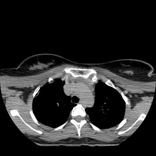 File:Choriocarcinoma of ovary with cerebral and pulmonary metastases (Radiopaedia 25983-26119 Axial non-contrast 104).jpg