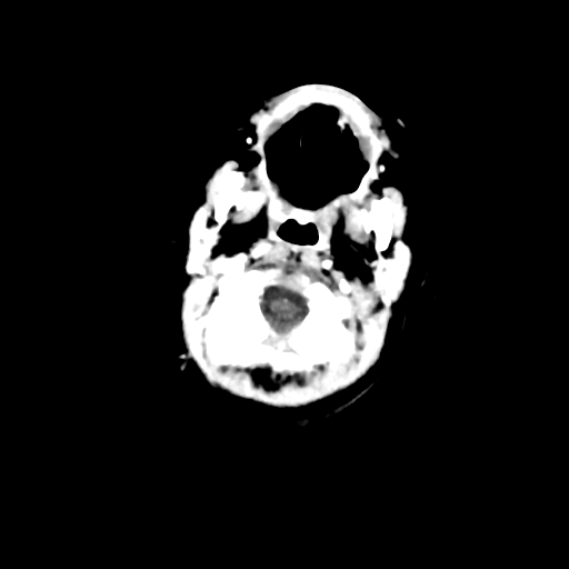 Choroid plexus papilloma (Radiopaedia 63946-72698 Axial with contrast 1).jpg