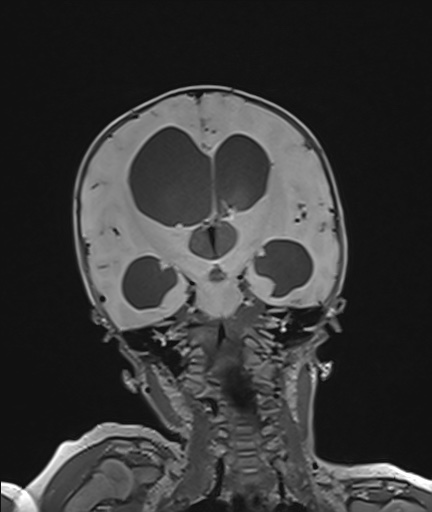 Choroid plexus papilloma (Radiopaedia 84612-100019 Coronal FLAIR 67).jpg