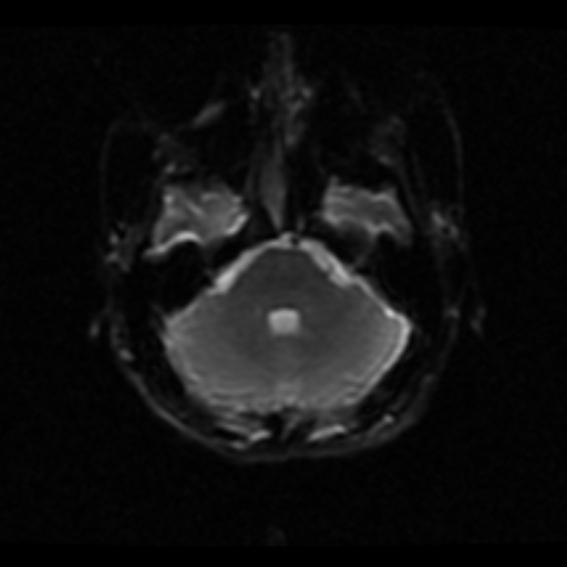 File:Choroid plexus xanthogranuloma (Radiopaedia 17650-17386 ADC 18).jpg