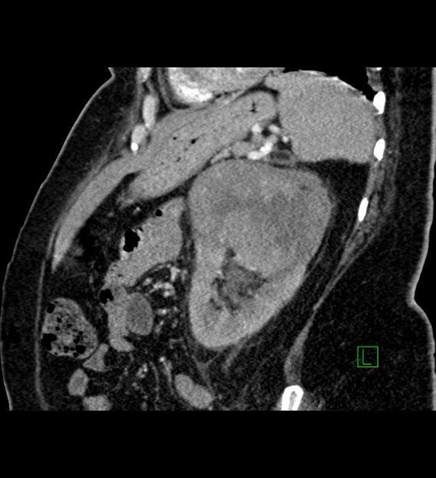 Chromophobe renal cell carcinoma (Radiopaedia 84239-99519 D 36).jpg