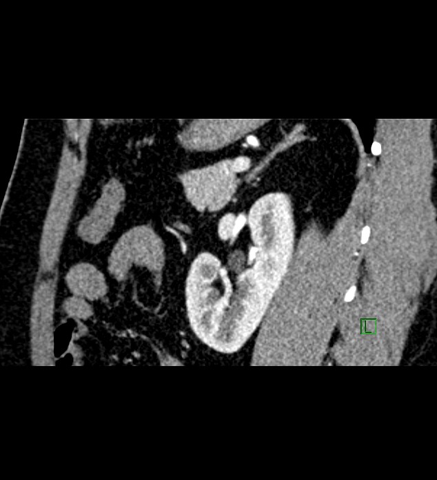 Chromophobe renal cell carcinoma (Radiopaedia 84286-99573 F 55).jpg