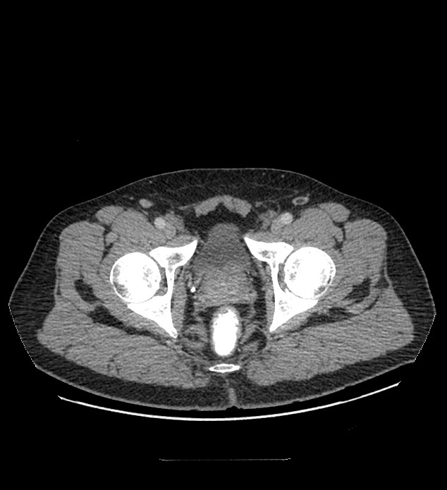 Chromophobe renal cell carcinoma (Radiopaedia 84337-99644 C 129).jpg