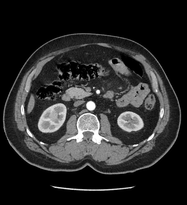 Chromophobe renal cell carcinoma (Radiopaedia 86879-103083 B 62).jpg