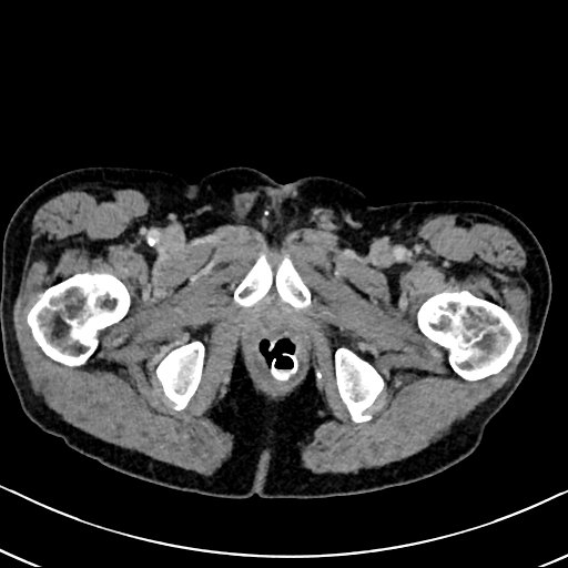 Chronic appendicitis complicated by appendicular abscess, pylephlebitis and liver abscess (Radiopaedia 54483-60700 B 151).jpg