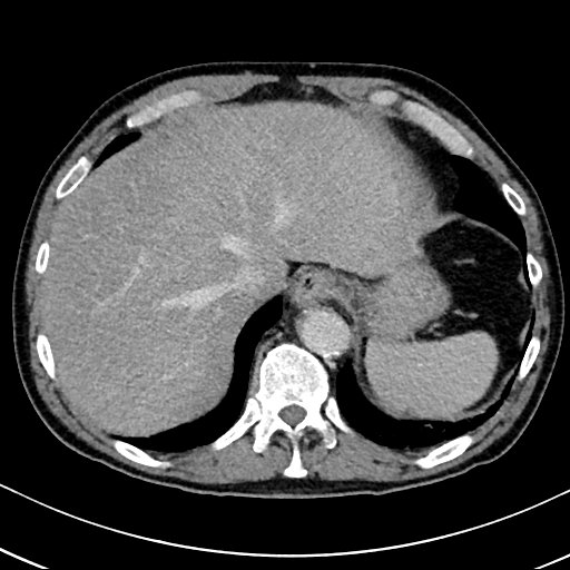 Chronic appendicitis complicated by appendicular abscess, pylephlebitis and liver abscess (Radiopaedia 54483-60700 B 31).jpg