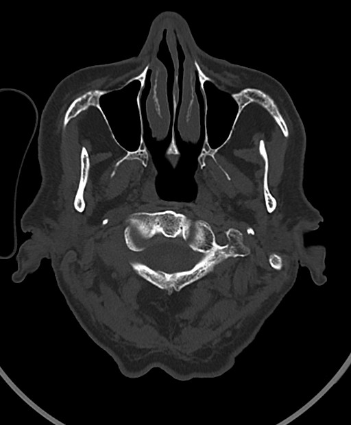 Chronic bilateral subdural hygroma (Radiopaedia 85801-101623 Axial bone window 115).jpg