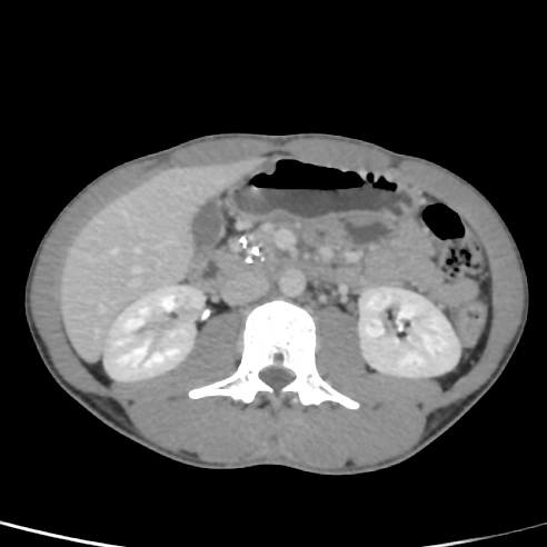 File:Chronic calcific pancreatitis (Radiopaedia 56280-62953 C 26).jpg