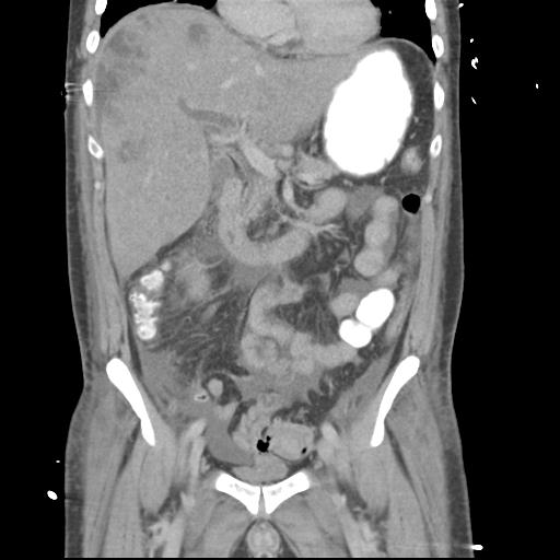 Chronic diverticulitis complicated by hepatic abscess and portal vein thrombosis (Radiopaedia 30301-30938 B 27).jpg