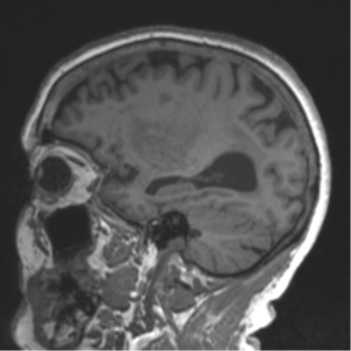 File:Chronic hypertensive encephalopathy (Radiopaedia 39993-42482 Sagittal T1 64).png