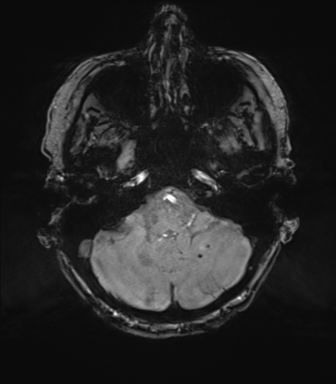 Chronic hypertensive encephalopathy (Radiopaedia 72844-83495 Axial SWI magnitude 16).png