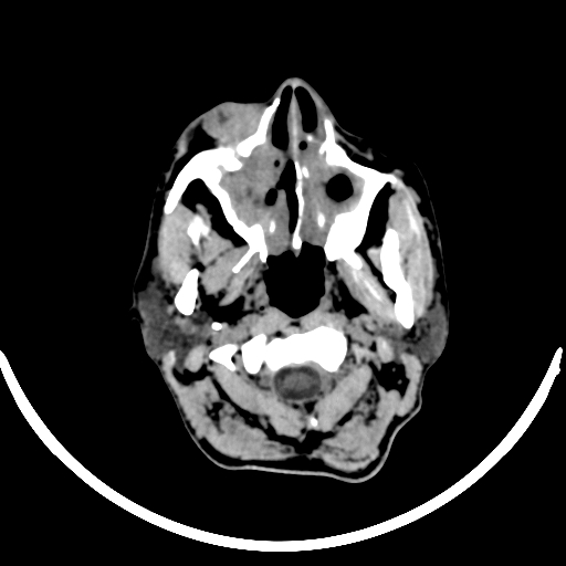 File:Chronic invasive fungal sinusitis with intraorbital and intracranial extension (Radiopaedia 56387-63046 Axial non-contrast 54).jpg