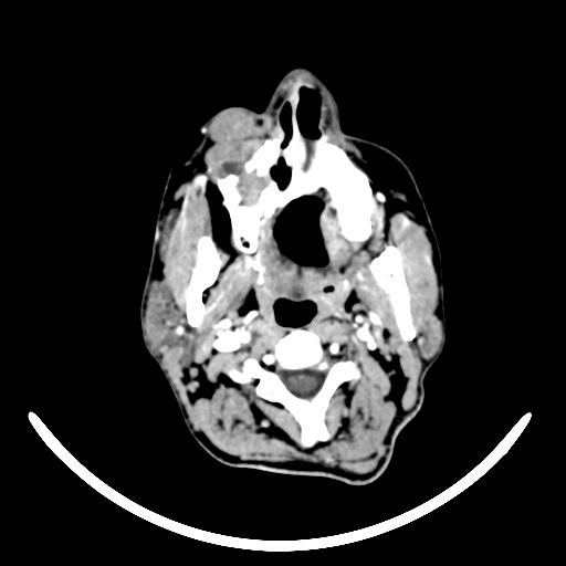 Chronic invasive fungal sinusitis with intraorbital and intracranial extension (Radiopaedia 56387-63046 B 6).jpg