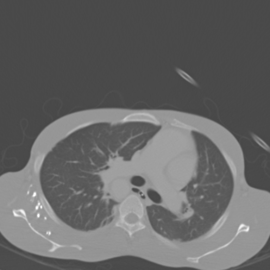 Chronic large bowel pseudo-obstruction (Radiopaedia 43181-46492 Axial bone window 6).jpg