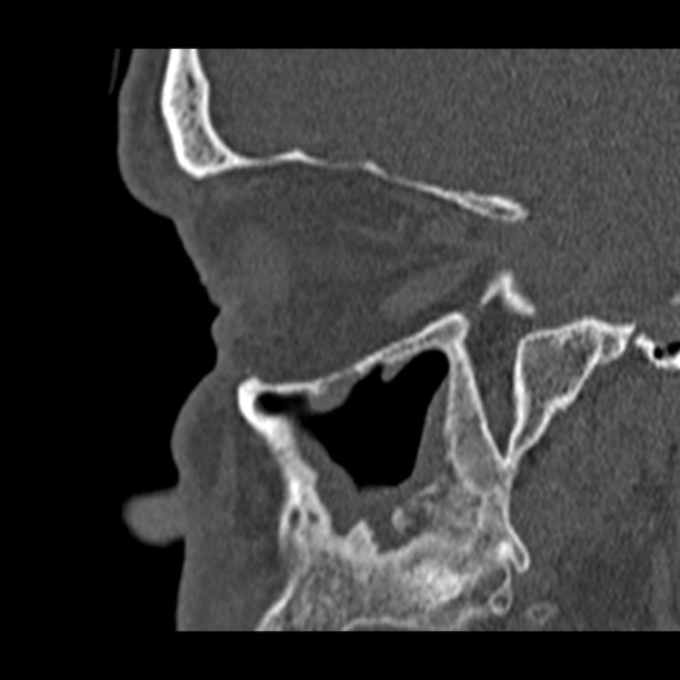Chronic maxillary sinusitis (Radiopaedia 27879-28116 Sagittal bone window 41).jpg