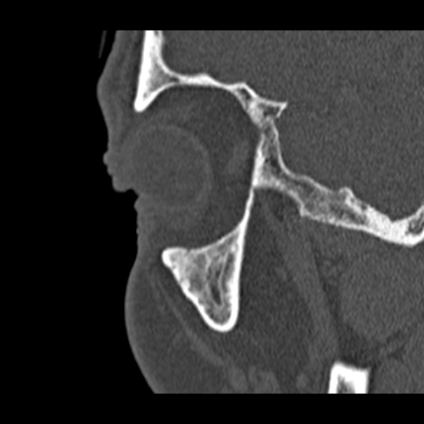 Chronic maxillary sinusitis (Radiopaedia 27879-28116 Sagittal bone window 53).jpg