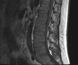 File:Chronic myeloid leukemia (MRI) (Radiopaedia 56128-62777 Sagittal T1 5).jpg
