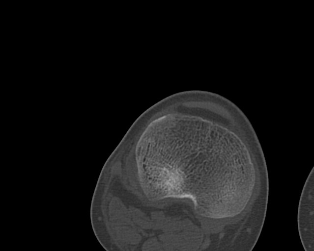 File:Chronic ostemyelitis of the femur with long sinus tract (Radiopaedia 74947-85982 Axial bone window 235).jpg