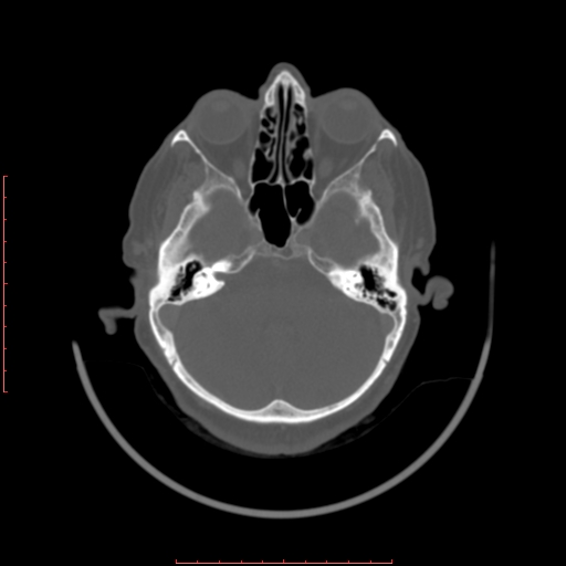 Chronic osteomyelitis - maxilla (Radiopaedia 23783-23927 Axial bone window 126).jpg
