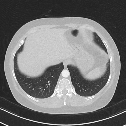 Chronic pulmonary embolus (Radiopaedia 39129-41341 Axial lung window 51).png