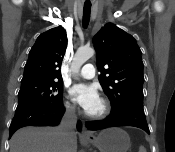 Chronic pulmonary embolus (Radiopaedia 39129-41341 Coronal C+ CTPA 41).png