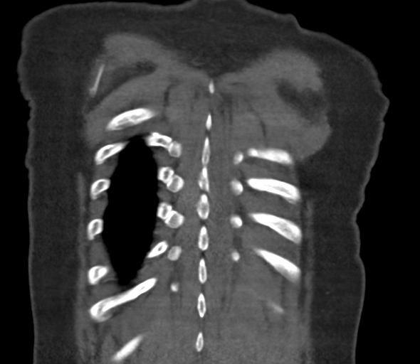 File:Chronic pulmonary embolus (Radiopaedia 39129-41341 Coronal C+ CTPA 76).png