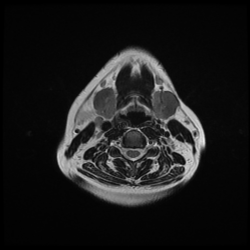 File:Chronic submandibular sialadenitis (Radiopaedia 61852-69885 Axial T2 17).jpg