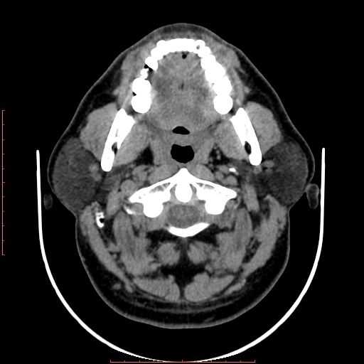 File:Chronic submandibular sialolithiasis (Radiopaedia 69817-79814 Axial non-contrast 62).jpg