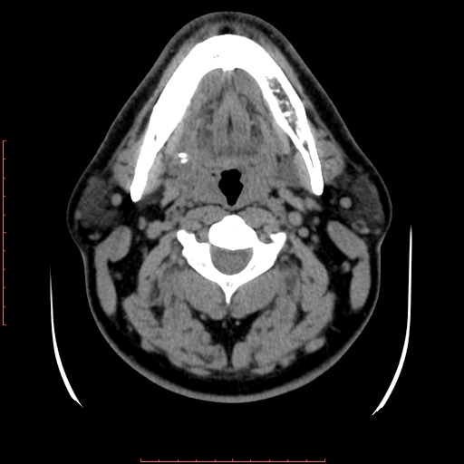 Chronic submandibular sialolithiasis (Radiopaedia 69817-79814 Axial non-contrast 98).jpg