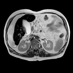 File:Cirrhosis and hepatocellular carcinoma in the setting of hemochromatosis (Radiopaedia 75394-86594 Axial T2 11).jpg