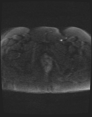 File:Class II Mullerian duct anomaly- unicornuate uterus with rudimentary horn and non-communicating cavity (Radiopaedia 39441-41755 Axial DWI 59).jpg