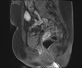 File:Class II Mullerian duct anomaly- unicornuate uterus with rudimentary horn and non-communicating cavity (Radiopaedia 39441-41755 G 52).jpg