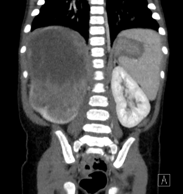 Clear cell sarcoma of kidney (Radiopaedia 60647-68379 C 46).png