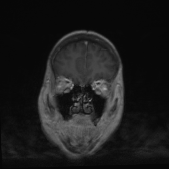 File:Clival meningioma (Radiopaedia 53278-59248 F 7).jpg