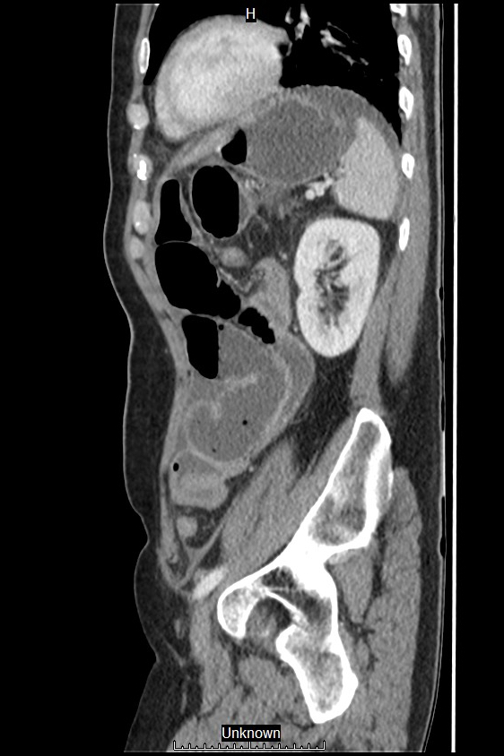 Closed loop bowel obstruction and ischemia (Radiopaedia 86959-103180 C 15).jpg