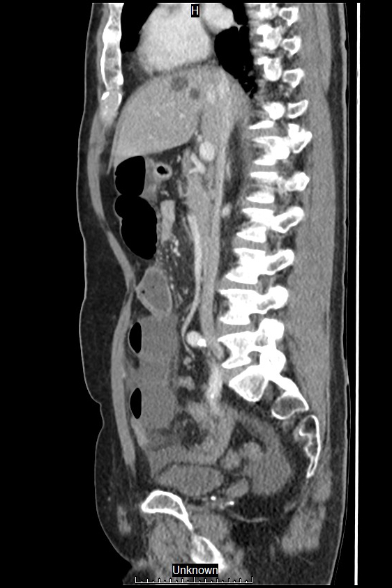 Closed loop bowel obstruction and ischemia (Radiopaedia 86959-103180 C 38).jpg