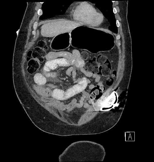 File:Closed loop obstruction - internal hernia into nephrectomy bed (Radiopaedia 59867-67320 B 24).jpg