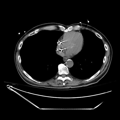 File:Closed loop obstruction due to adhesive band, resulting in small bowel ischemia and resection (Radiopaedia 83835-99023 Axial non-contrast 12).jpg