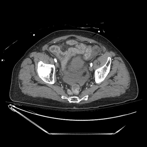 File:Closed loop obstruction due to adhesive band, resulting in small bowel ischemia and resection (Radiopaedia 83835-99023 B 133).jpg