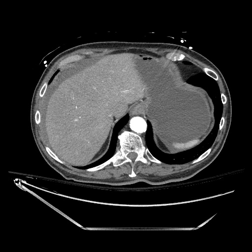 File:Closed loop obstruction due to adhesive band, resulting in small bowel ischemia and resection (Radiopaedia 83835-99023 B 29).jpg